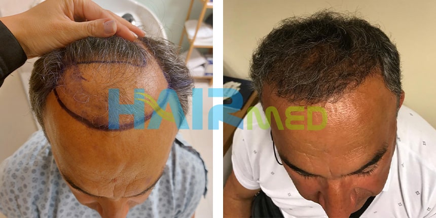 Avant et Après une Greffe de Cheveux