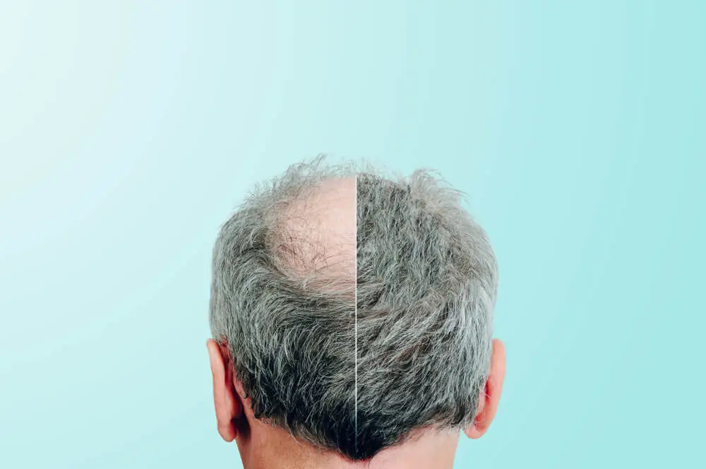 Greffe de Cheveux Avant et Après
