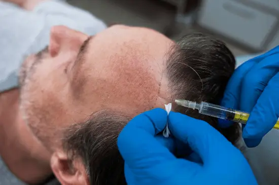 How to reduce edema after hair transplantation