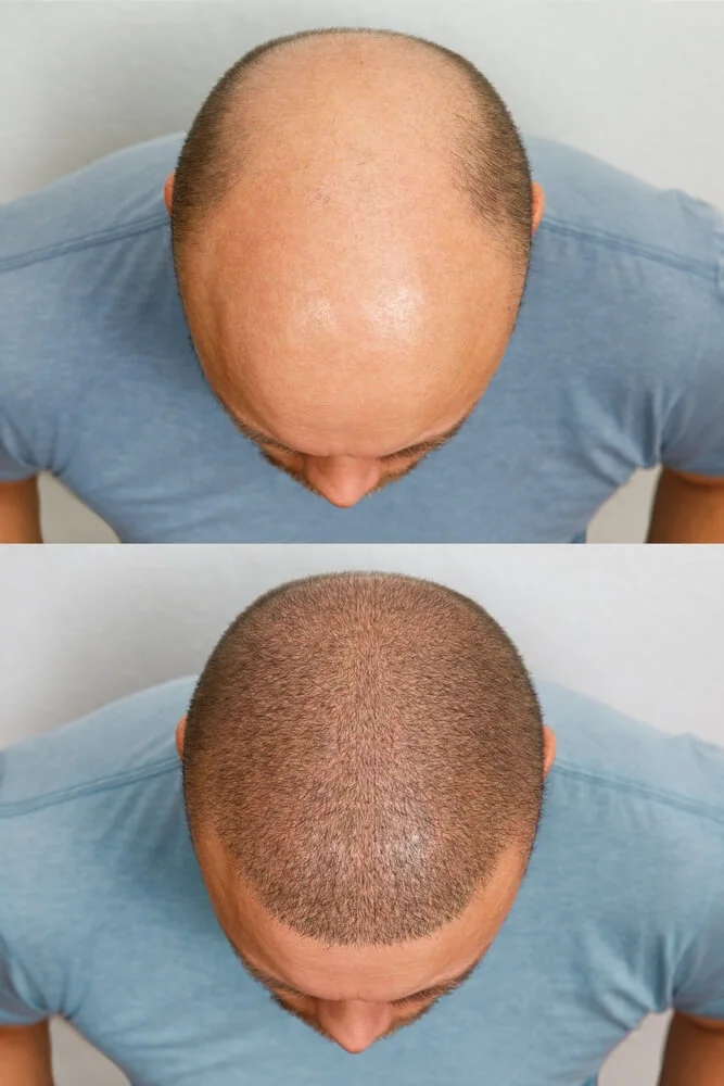 What to Do After Hair Transplantation