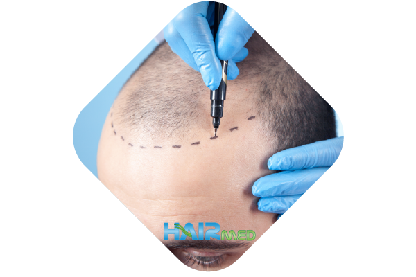Hair transplantation with FUE technique