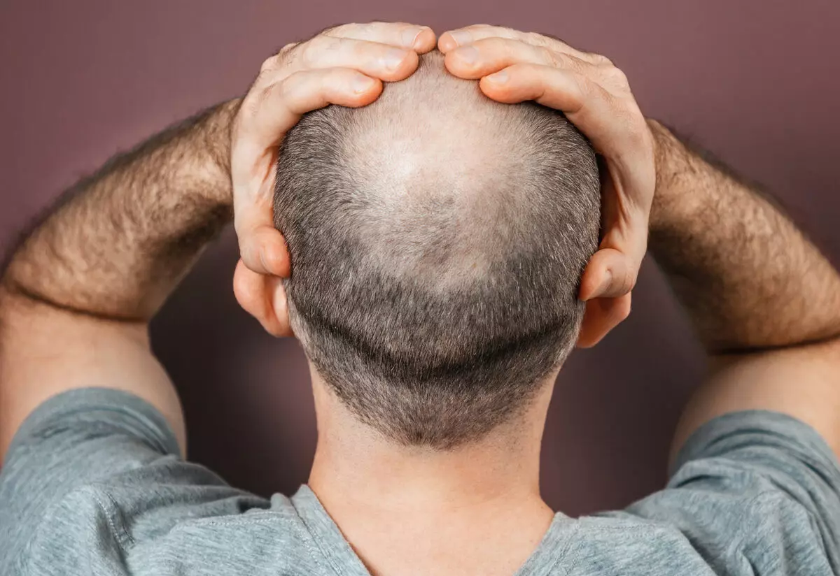 Where Does the Baldness Gene Come From?