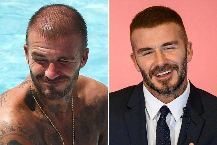Celebrities and Hair Transplantation: Transformation in front of the eyes