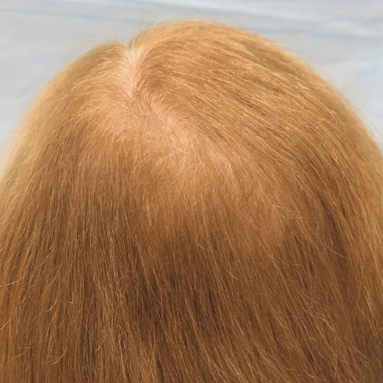After Hair Transplant