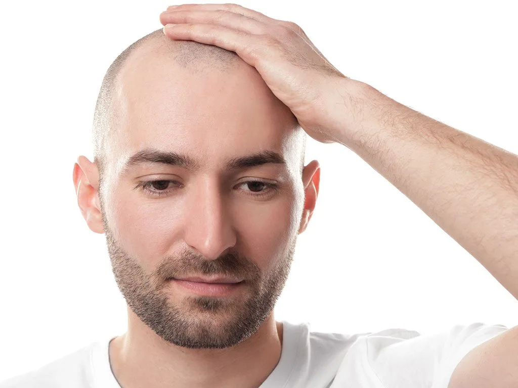 Male Pattern Baldness: 5 Main Causes and Prevention Methods