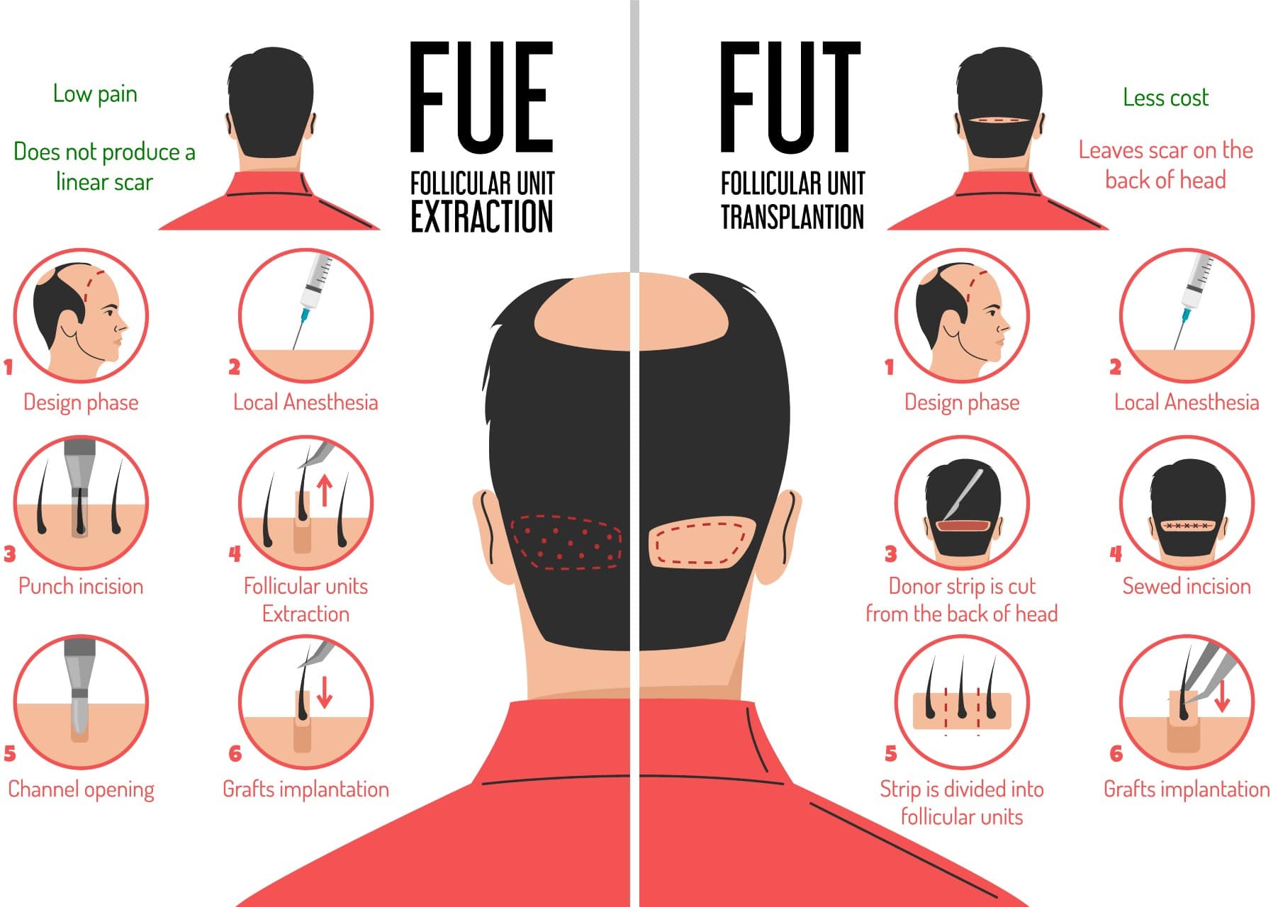 Hair Transplantation with FUE Technique - Hair-Med