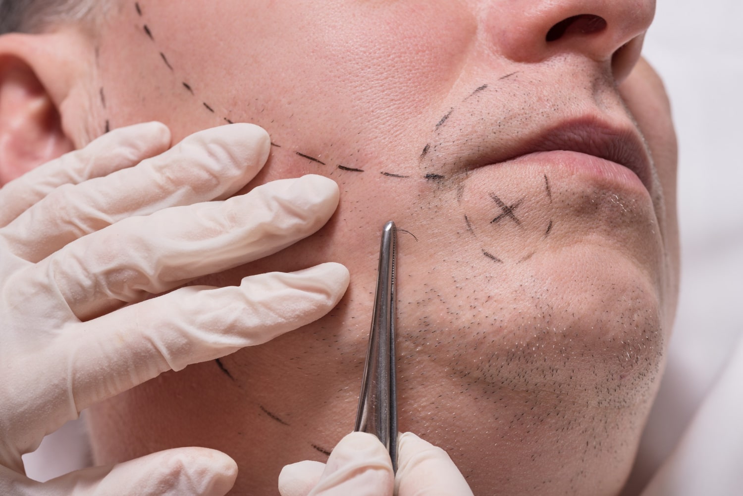 Beard transplant in Turkey prices and cost in Antalya