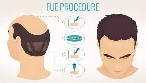 FUE-Haartransplantation die Ausführung – Hair Med