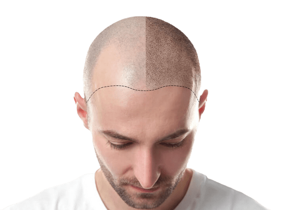 Hair Transplantation in Turkey Antalya Istanbul Izmir