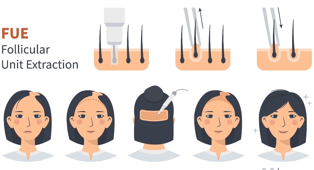 Hair Transplantation with FUE Technique in Antalya Turkey
