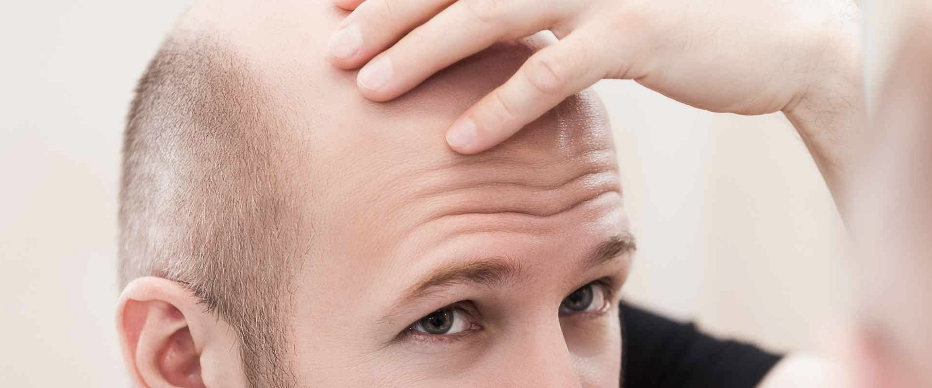 hair transplant prices 2022 2023 2024 turkey antalya istanbul izmir ankara