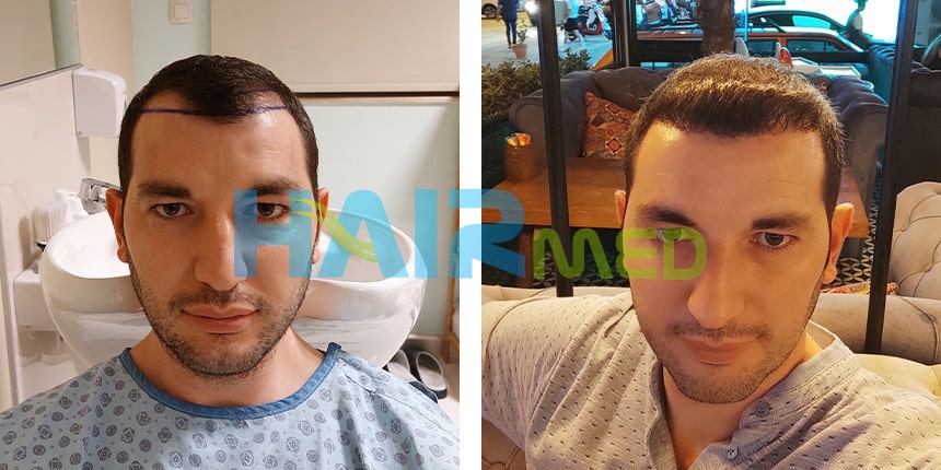 turkey before hair transplant after hair transplant 1-5