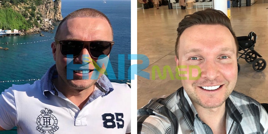 vor haartransplantation nach haartransplantation türkei antalya 1-4 2000 grafts vorher nachher